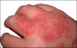 viral eczema