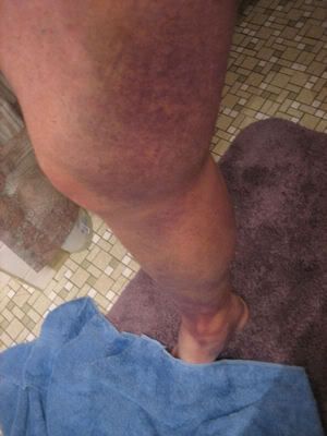 Endometrial cancer in 30s fine remedy for degree 1 cervical most cancers