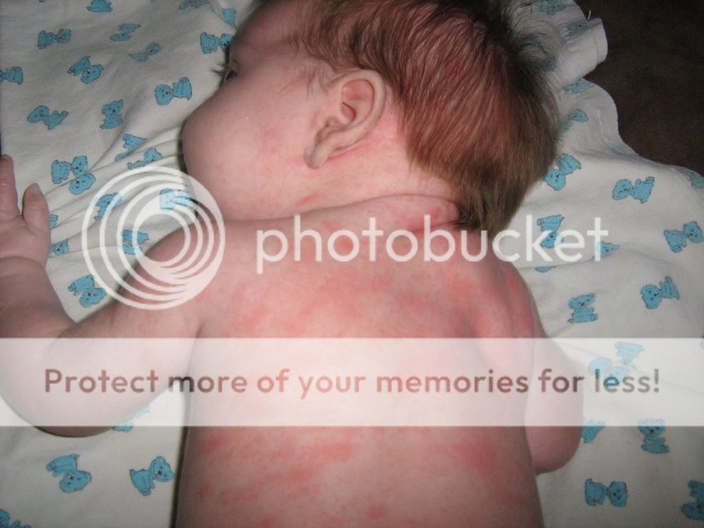 my-baby-had-an-allergic-reaction-page-2-babycenter