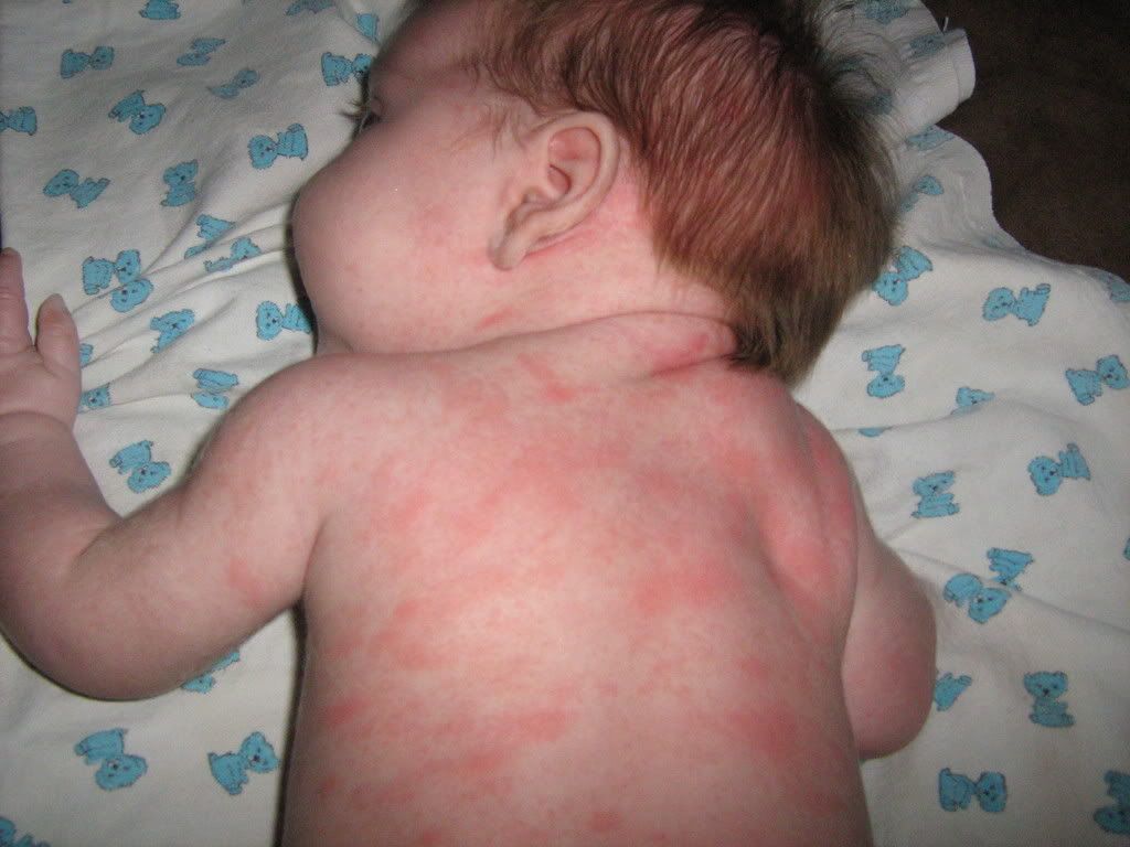 My Baby Had An Allergic Reaction Page 2 BabyCenter